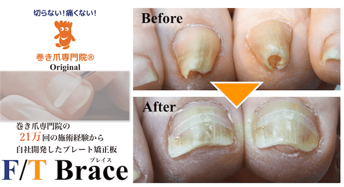 巻き爪専門グループ通算実績